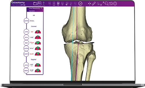 Fine-Osteotomy_1