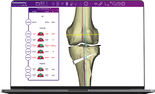 Fine-Osteotomy_2