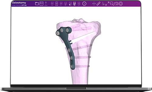 Fine-Osteotomy_3